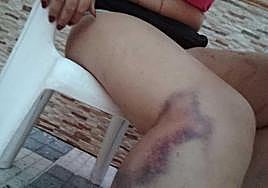 Inma muestra las lesiones que tenía en una pierna.