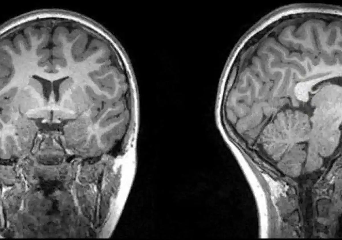 Los medicamentos que ponen en peligro tu cerebro, según Harvard.