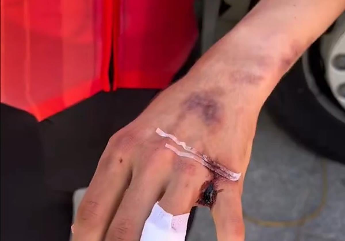 Mano de Carlos Rodríguez, este jueves, tras la caída de este miércoles