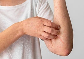 Las enfermedades inflamatorias inmunomediadas pueden ser de tipo reumatoide, dermatológico o gastrointestinales.