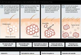 Diagnostican en Almería cien melanomas al año, y cada vez en población más joven