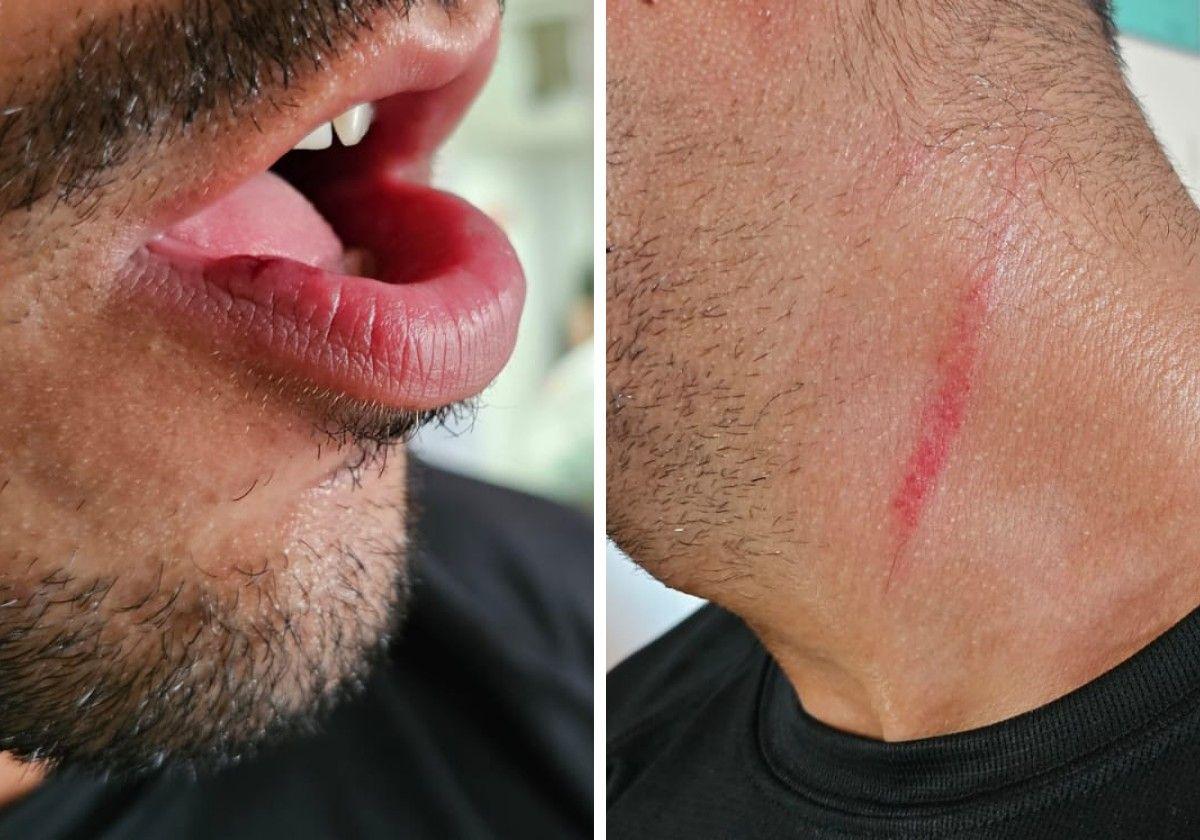 Heridas sufridas por el entrenador del Inter Granada agredido tras un partido de Tercera Andaluza.