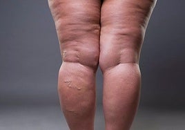 Las piernas de una mujer con lipedema.