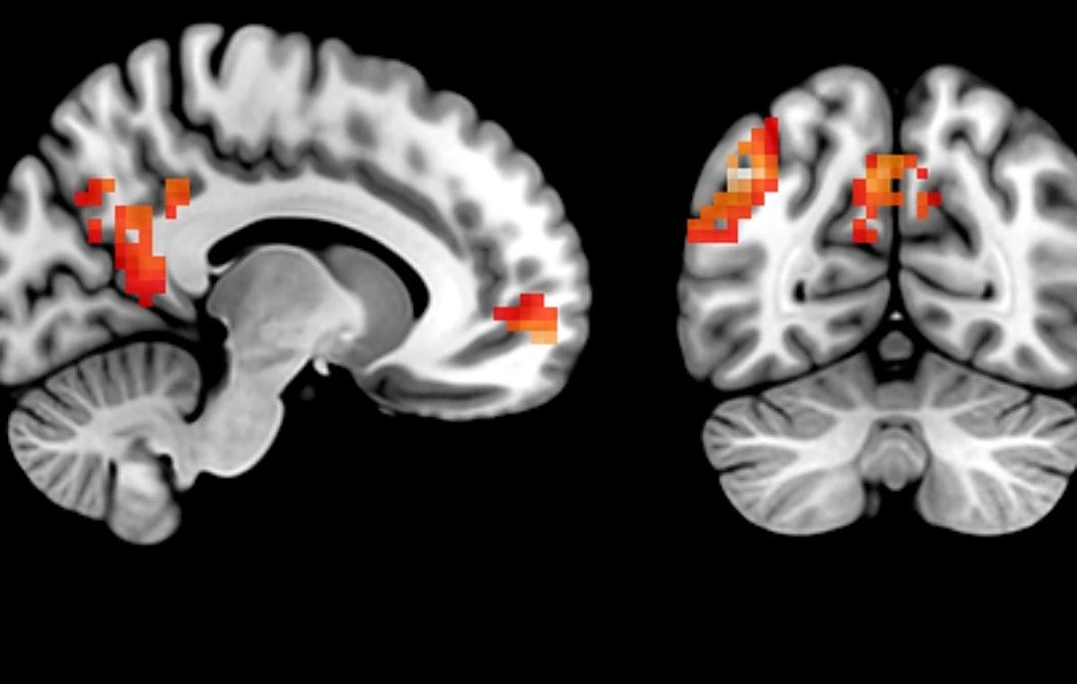 Áreas cerebrales de mayor activación al comparar el recuerdo de mensajes personalizados vs. no personalizados