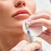 Inyección de ácido hialurónico para aumento de labios.