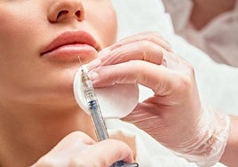 Inyección de ácido hialurónico para aumento de labios.