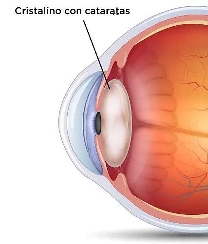 Imagen secundaria 2 - Entrevista al Dr. José Lucena, oftalmólogo especialista en VISIÓON Oftalmólogos