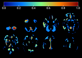 Imágenes de un cerebro afectado por enfermedad de Alzhéimer.