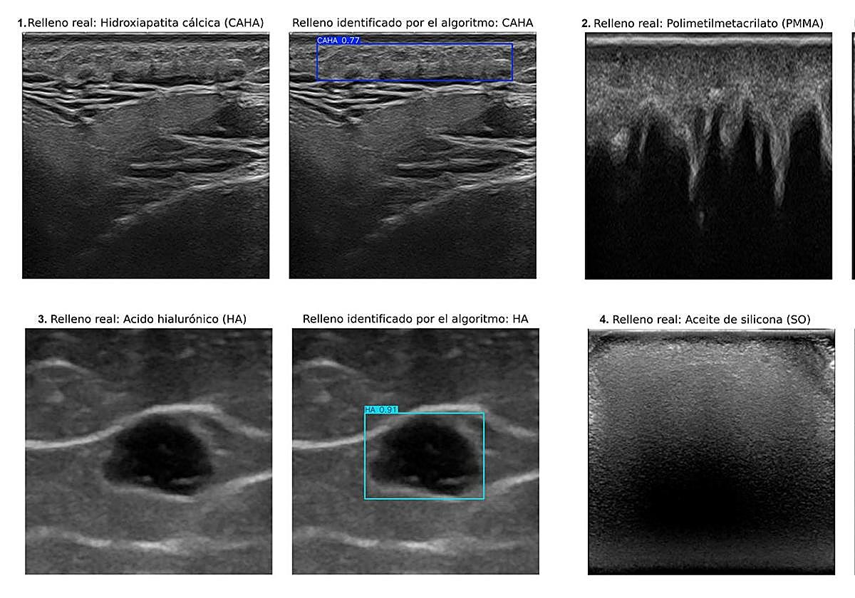 Un sistema de inteligencia artificial permite identificar rellenos estéticos en la piel mediante ecografías