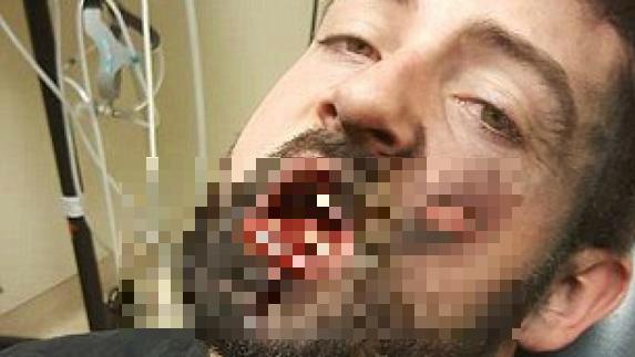 Sufre quemaduras y pierde 7 dientes al explotarle un cigarrillo electrónico en la boca