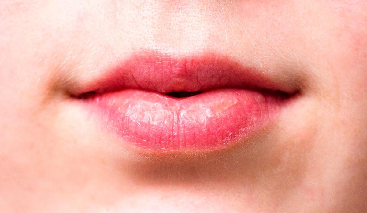 Labios secos.