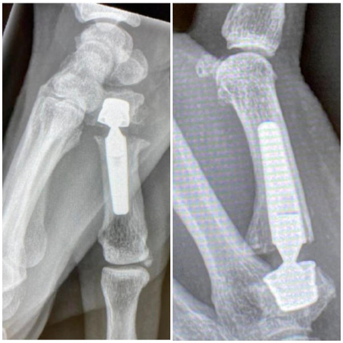 Radiografías de una artroplastia de pulgar como la que se expondrá en las sesiones clínicas de la FHGST.