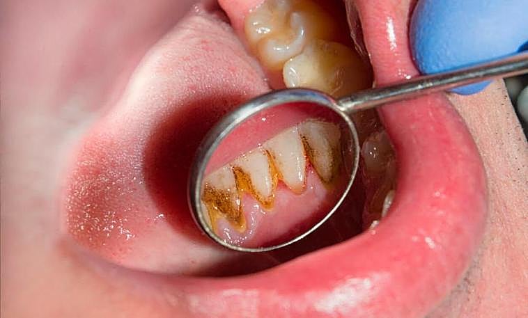 Una dentadura con sarro.