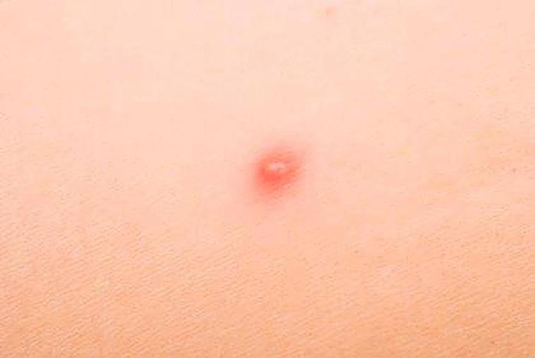 La viruela del mono: qué es, síntomas y cómo se contagia