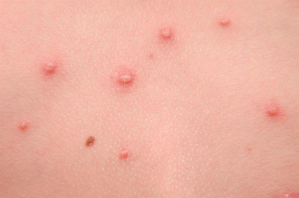 Efectos de la viruela del mono en la piel.