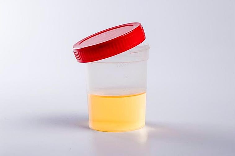 Recipiente de plástico con análisis de orina sobre un fondo blanco