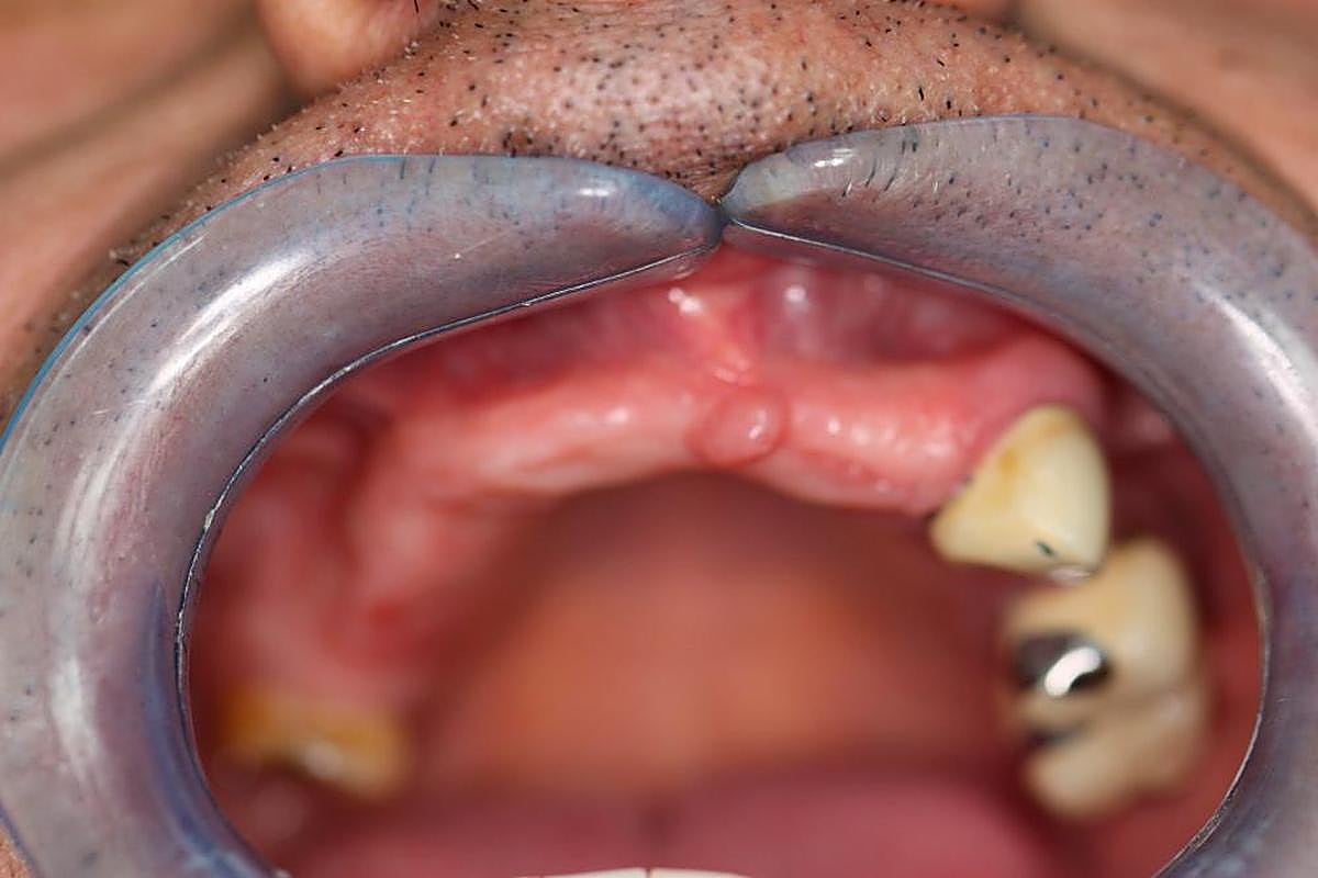 PASO 4. Inicio de la intervención.