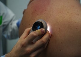 Examen de los lunares de la espalda en la consulta de Dermatología.