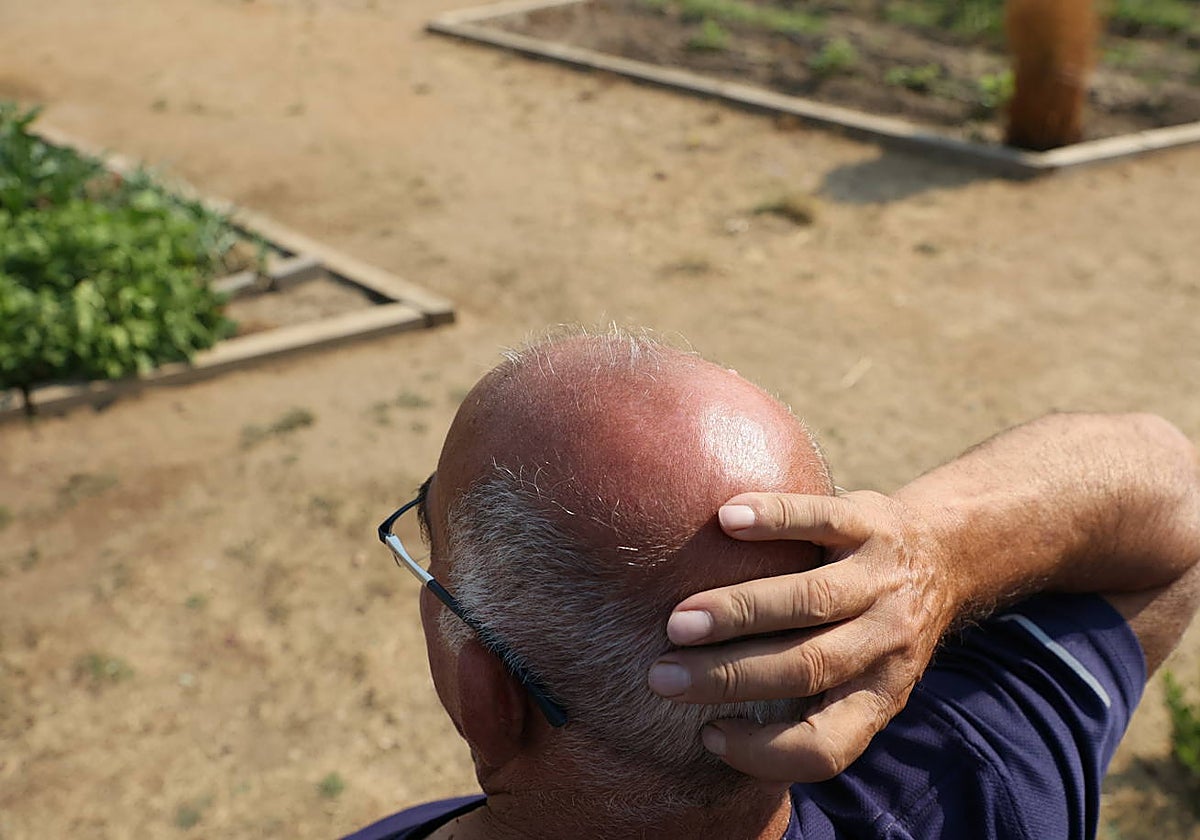 Un hombre con alopecia se lleva la mano a la cabeza.