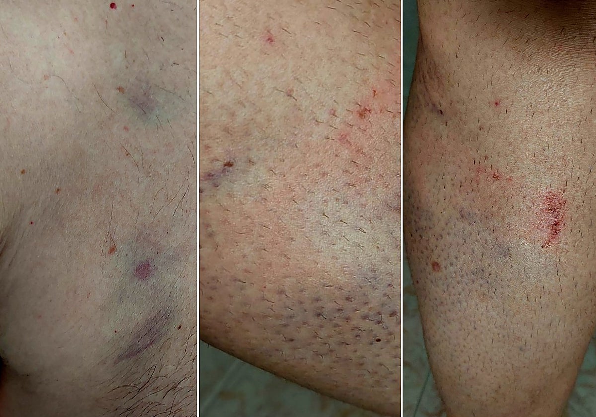 Imágenes de las heridas sufridas por los funcionarios del centro penitenciario de Topas.