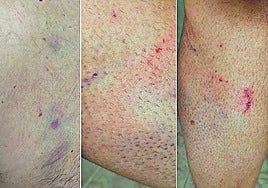 Imágenes de las heridas sufridas por los funcionarios del centro a principios de septiembre en el módulo 6.