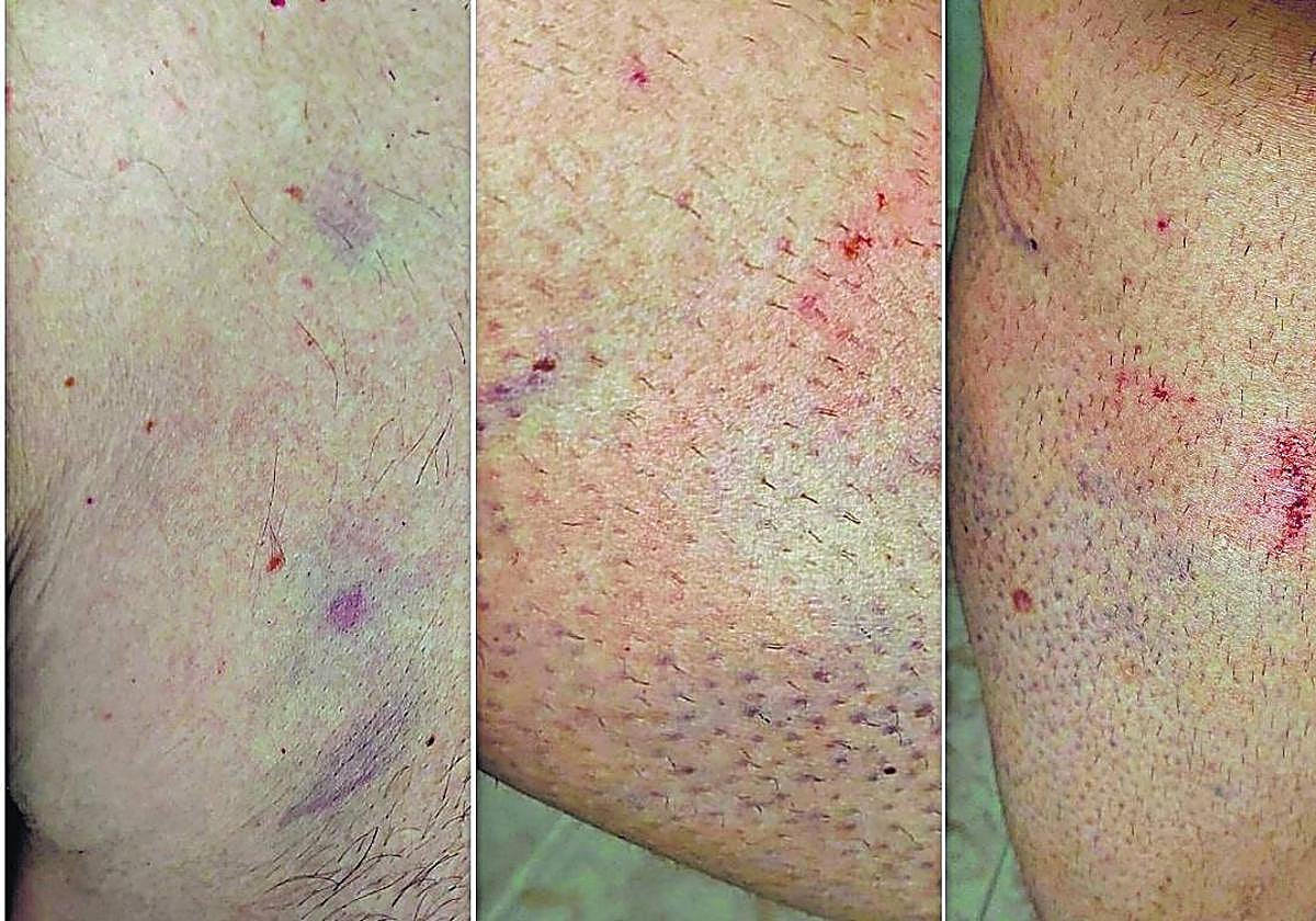 Imágenes de las heridas sufridas por los funcionarios del centro a principios de septiembre en el módulo 6.