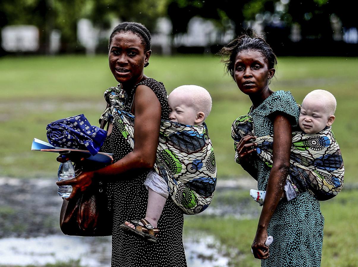 El drama de los albinos de Tanzania