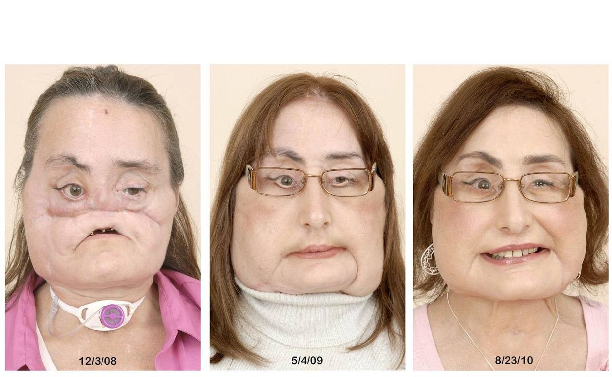 Imagen del rostro de Connie Culp antes y después de la operación. 