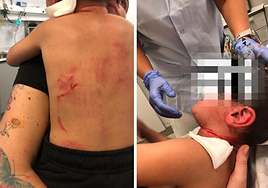 Operado en Valdecilla un niño de 4 años tras ser mordido en el cuello por un perro en Vizcaya