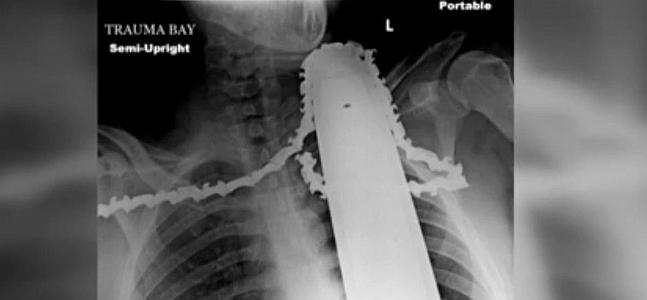 Una radiografía revela el daño que ocasionó la motosierra. / Atlas
