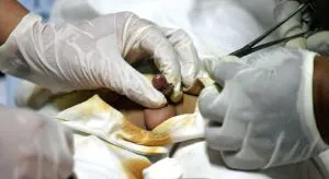 Dos médicos practican una circuncisión a un niño. / EFE
