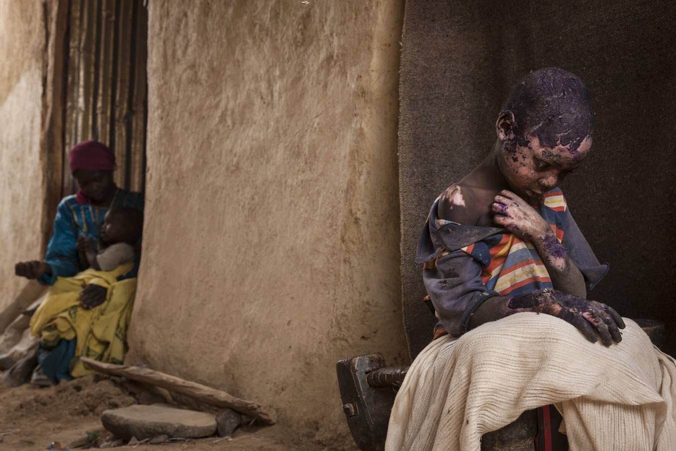 Ganadora del segundo premio individual en la categoría de Problemas Contemporáneos tomada por la estadounidense Adriane Ohanesian. Muestra a Adam Abdel de 7 años gravemente quemado después de que una bomba lanzada por el gobierno sudanés cayera junto a la casa de su familia en Burgu (Sudán) el 27 de febrero de 2015.