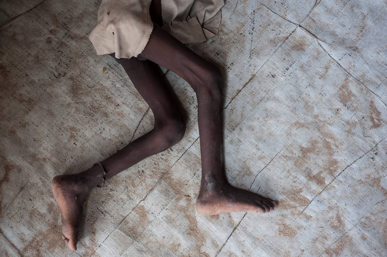 Malnutrición terrorista en Nigeria. Un niño malnutrido en el campamento de Muna , en las afueras de Maiduguri, capital del estado de  Borno, en el nordeste Nigeria. La ONU cree que 50.000 niños pueden morir de hambre en la zona, donde el terrorismo de Boko Haram ha sacado a decenas de miles de personas de sus casas. AFP PHOTO / STEFAN HEUNIS