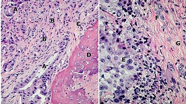 Imágenes histológicas de un cáncer de pulmón infiltrando parrilla costal (izquierda) y de un mesotelioma pleural (derecha). Cortes de inclusión en parafina, tinciones de H&E. En la imagen de la izquierda se observa una proliferación epitelial de patrón glanduliforme, relativamente bien definida (A), y mal definida (B), que induce una reacción estromal desmoplásica (C), y engloba una trabécula ósea (D). La celularidad expresa TTF-1 (adenocarcinoma pulmonar). La imagen de la derecha muestra un nido sólido tumoral con celularidad de hábito epitelioide (E), con algunas células tumorales dispersas (F) en el seno de un estroma laxo de colágena (G). La celularidad expresa calretinina (mesotelioma)