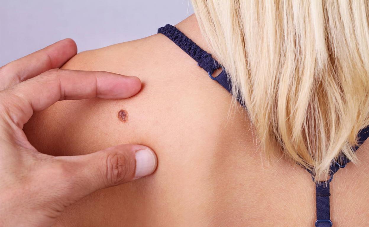 El Hospital General de Alicante lleva detectados 25 casos de melanoma hasta agosto