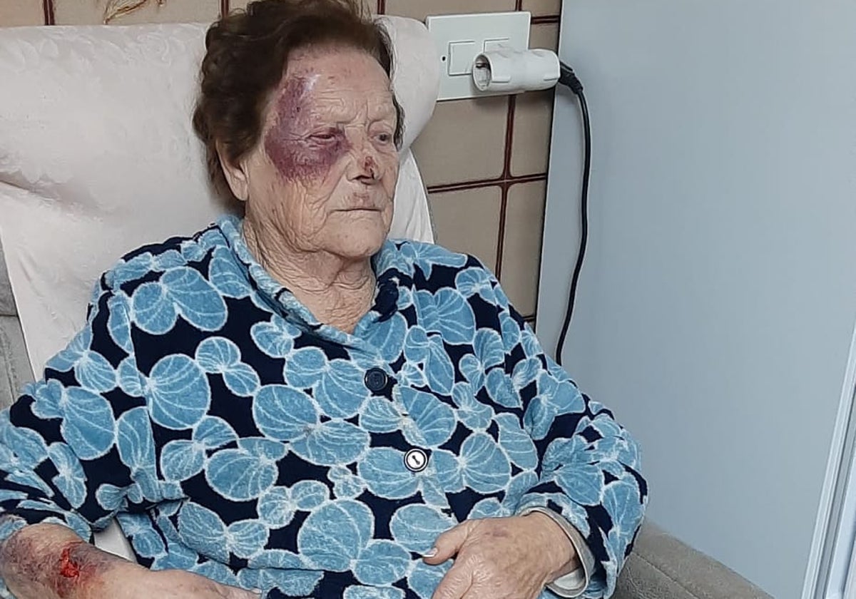 La anciana agredida con moratones en la cara y el brazo derecho.