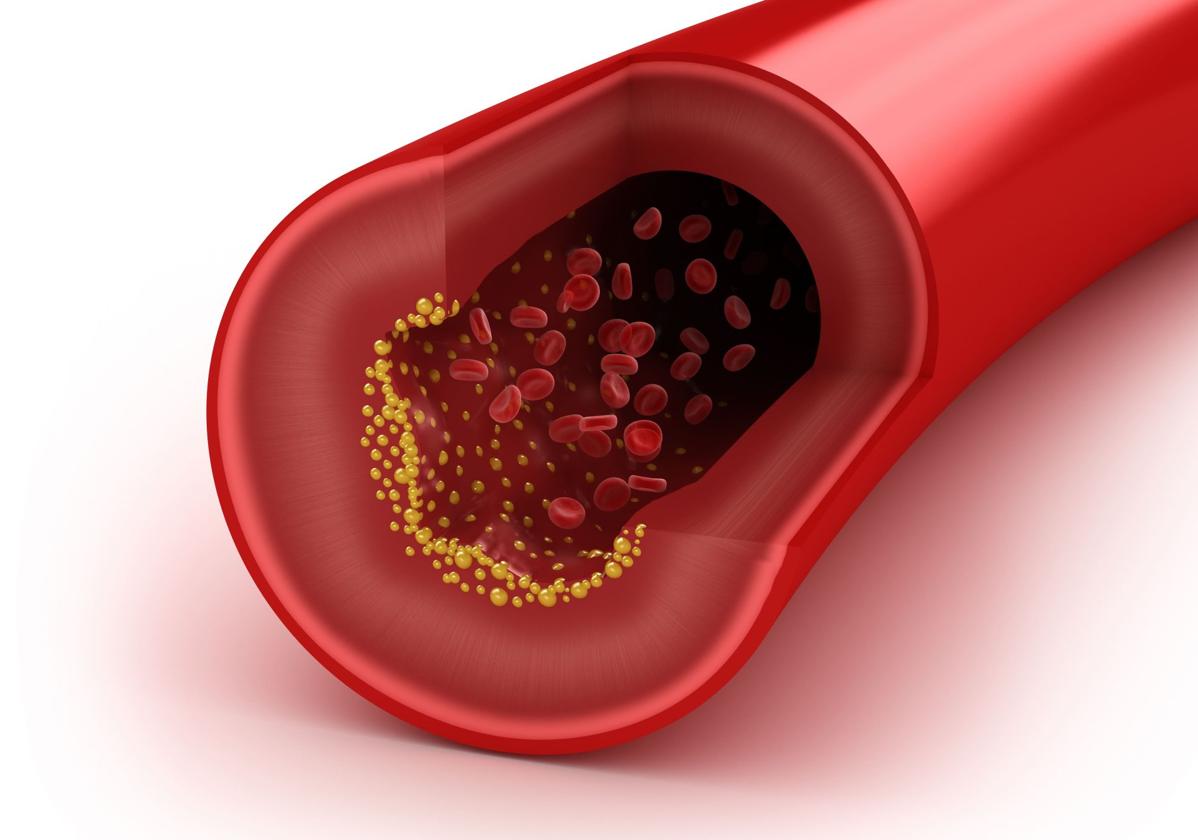 Aviso importante de los expertos en colesterol