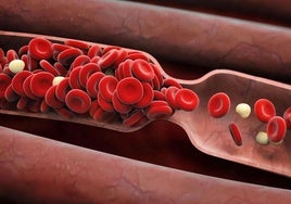 Importante descubrimiento de expertos españoles en colesterol: la inhibición de una proteína podría retrasar la progresión de la aterosclerosis