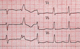 Un electrocardiograma, en una imagen de archivo.