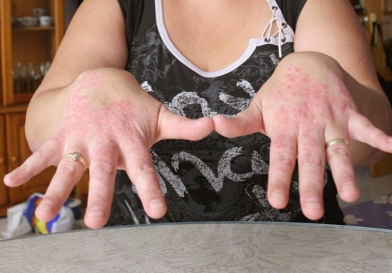 Una paciente con psoriasis en las manos.