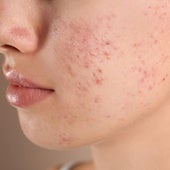 Qué es la disbiosis en la microbiota y qué problemas deja en la piel