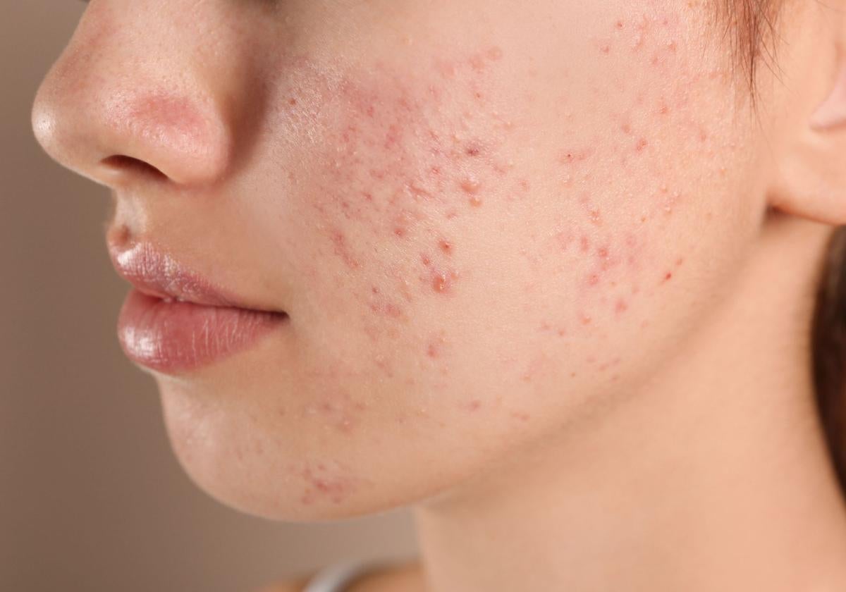 Los problemas en la piel pueden estar relacionados con el estado de la microbiota.