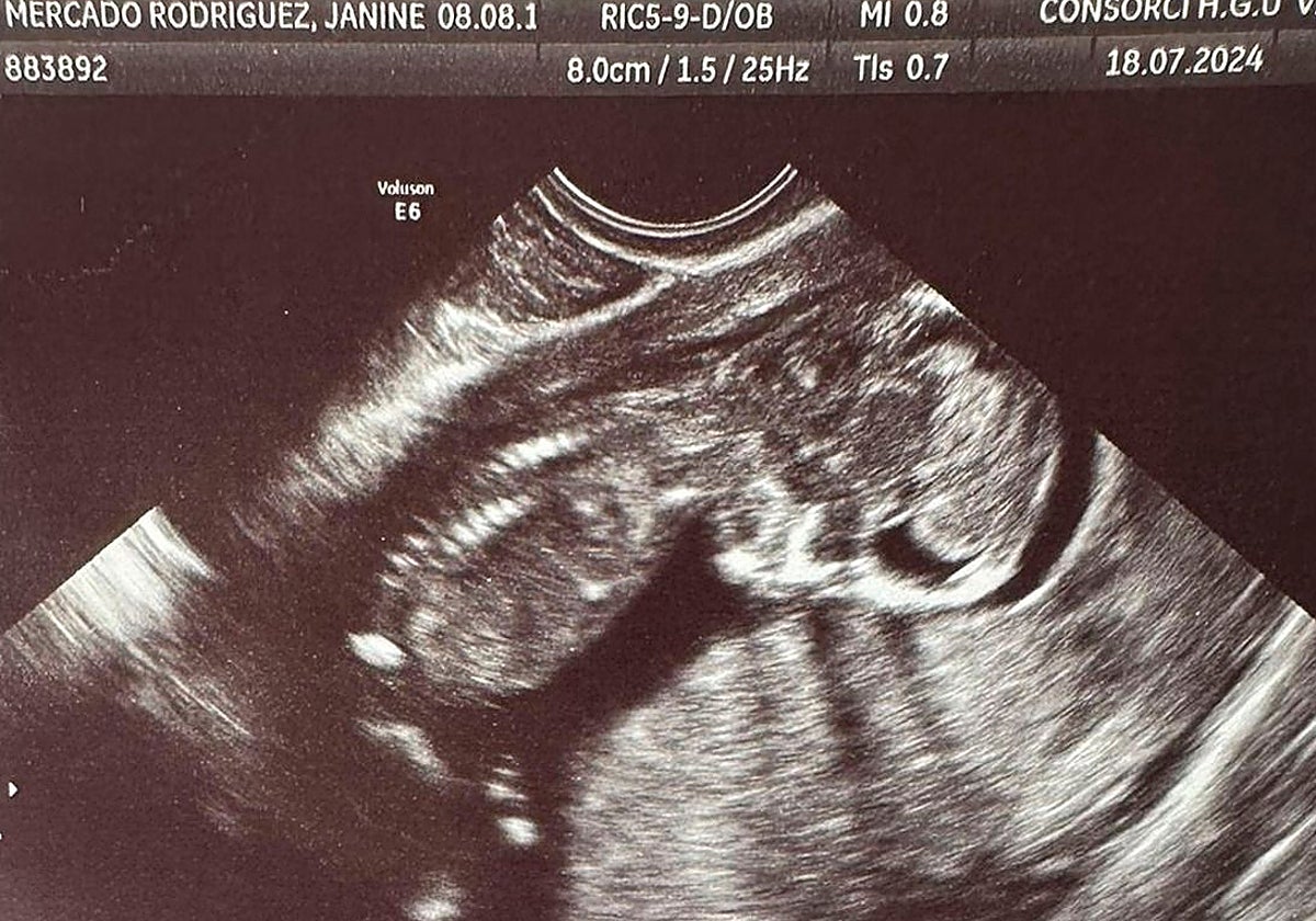 Escarlett, la nonata de ocho meses de gestación, en una imagen de ecografía facilitada por su abuela.