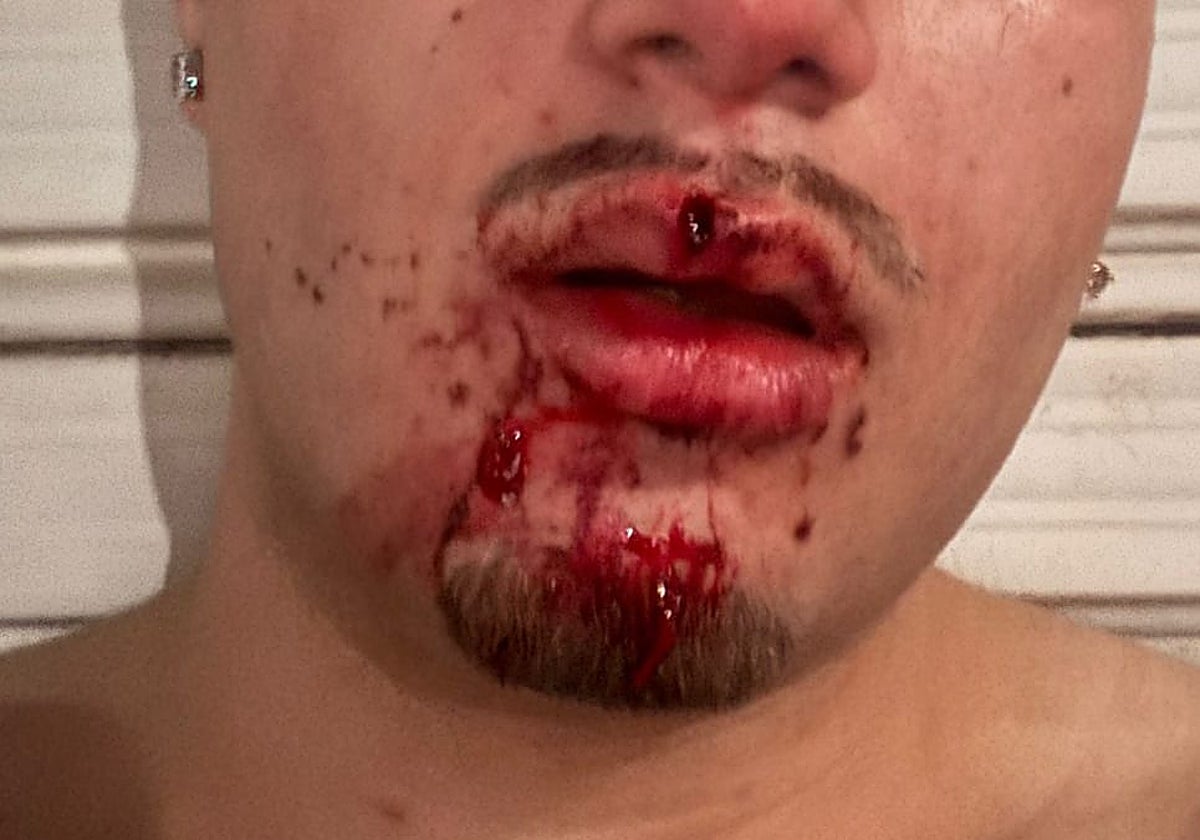 Uno de los jóvenes heridos en la reyerta tras recibir un botellazo en la cara.