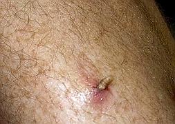 Un español, el primer humano infestado por larva de mosca