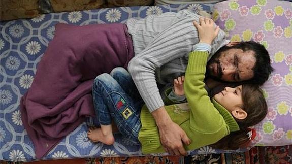 La niña, con su padre, mutilado y ciego en el sur de Turquía.