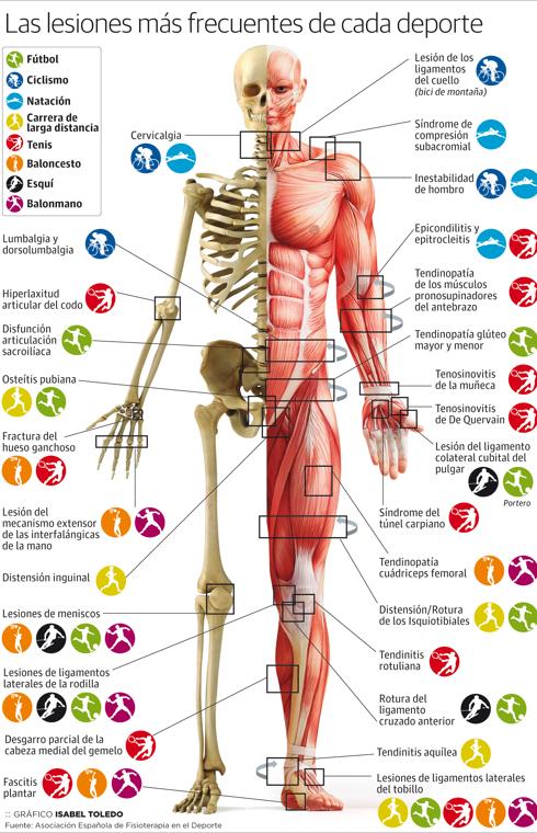 Pincha para el ver el gráfico del mapa de las lesiones en los deportes.