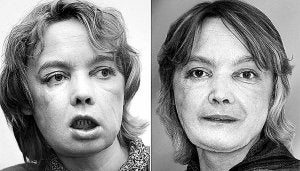 Isabelle Dinoire, la primera trasplantada facial,antes y después. ::
LP