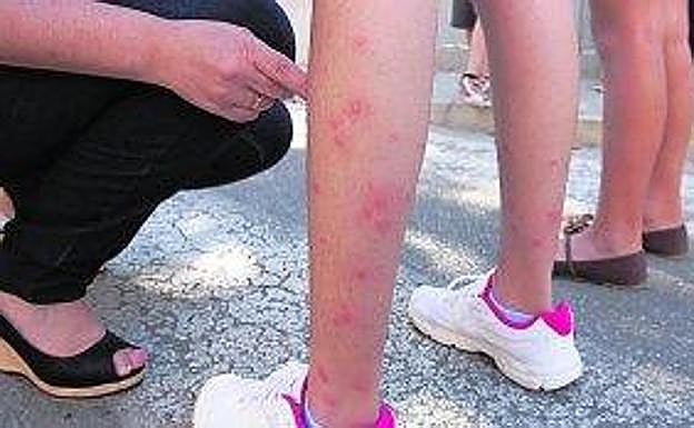 Picaduras de mosquito tigre