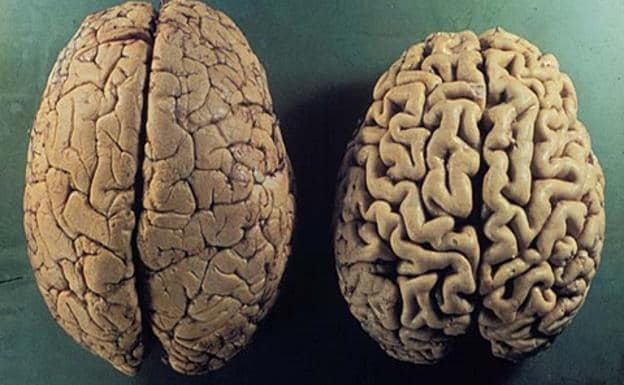 Un cerebro sano (izda.) frente al cerebro de un afectado por el alzhéimer. 